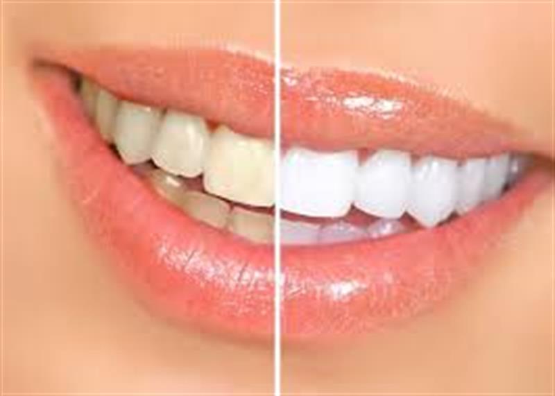 سفیدکننده های طبیعی دندان را بشناسید