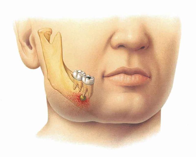 درمان پیله دندان