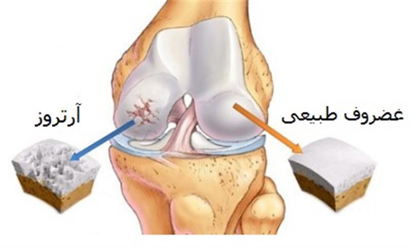 درباره آرتروز زانو بیشتر بدانیم