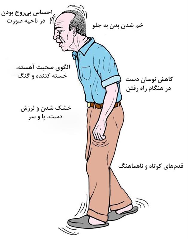 پارکینسون چیست