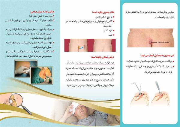 سینوس پایلونیدال2