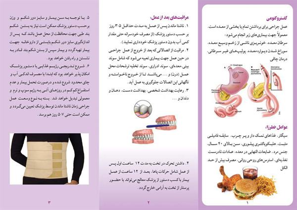 گاستروکتومی2