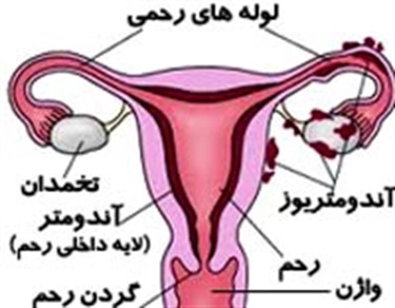آندومتریوز چیست