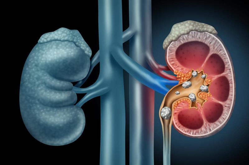 در مورد عمل خارج کردن سنگ کلیه از راه سوراخ کوچک پوست (PCNL) بدانید