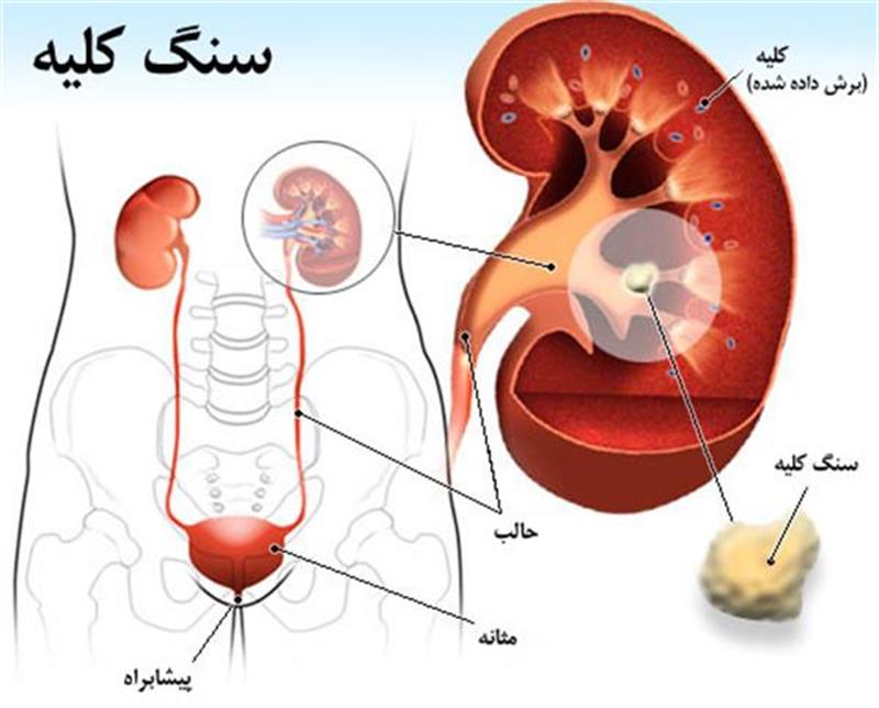 درمورد کلیه و بیماری های آن چه می دانید؟