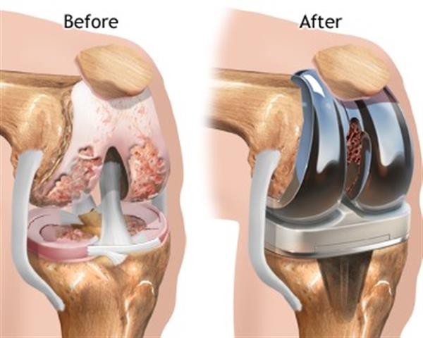 Knee replacement